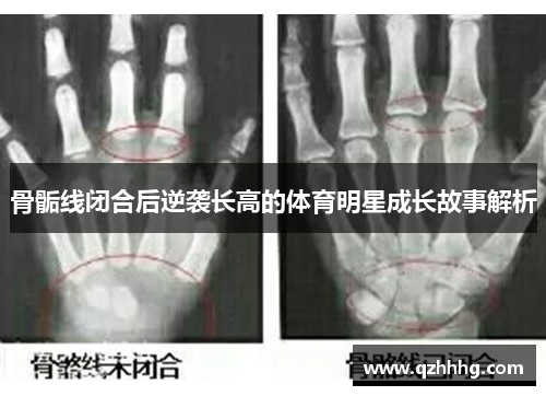 骨骺线闭合后逆袭长高的体育明星成长故事解析
